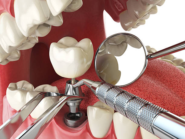 Best Emergency Tooth Extraction in Bedminster, NJ